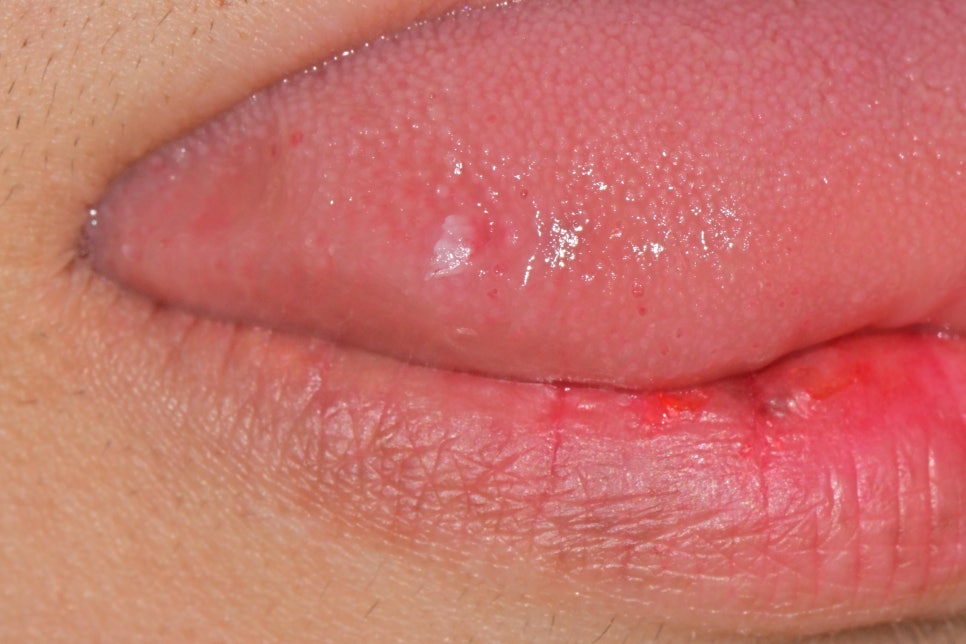 개롱역 치과 혀에 하얀 돌기? 구강 유두종 작아도 조직검사가 필요한 이유 관련 이미지 1