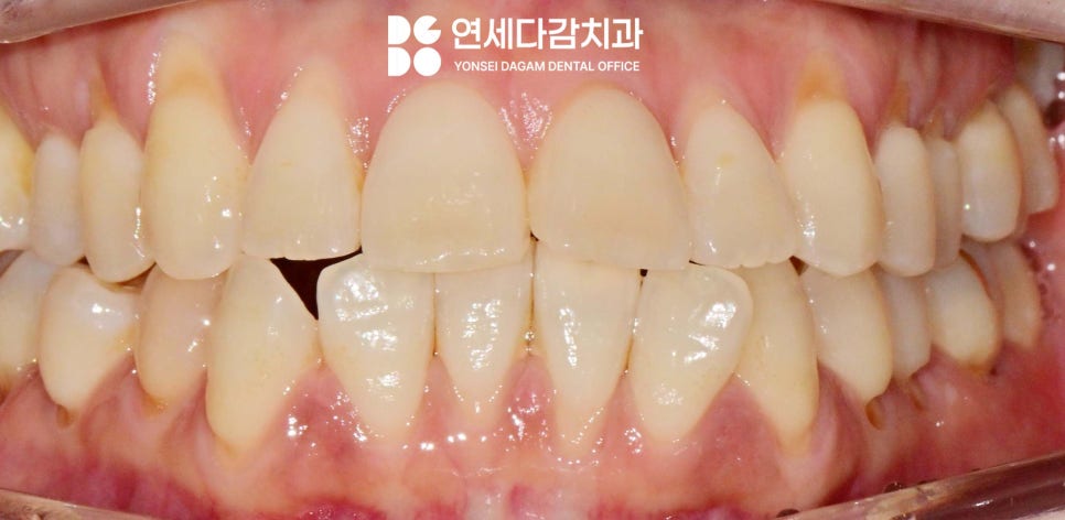 이시림 원인 치경부 마모증 치료할 때 쓰이는 문정역 치과 레진과 G.I 재료의 특성 관련 이미지 1