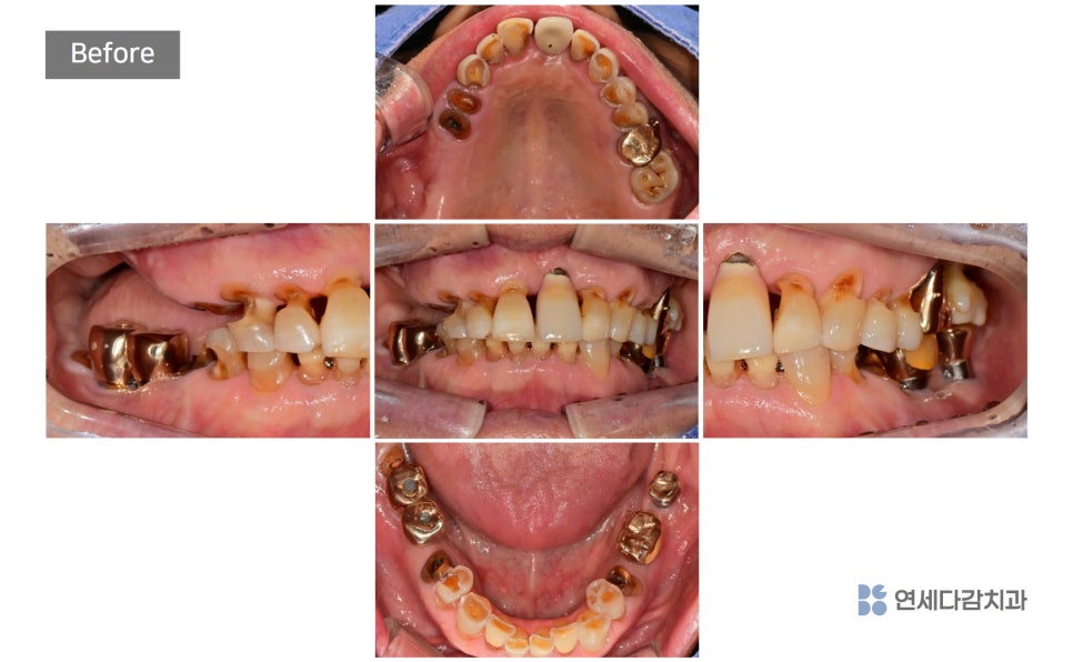 Munjung-dong Dentist: What Does Tooth Attrition Mean, What Are Its Symptoms, and How Is It Treated? image 12