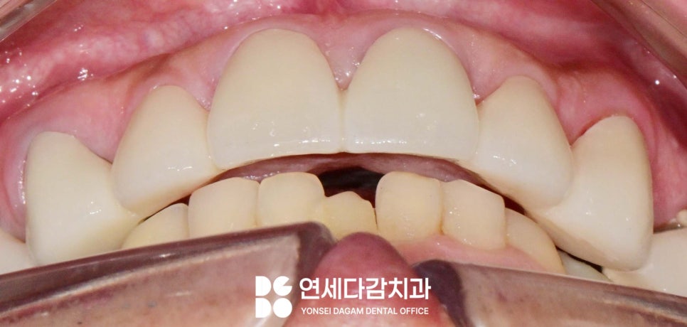 치주염 원인으로 치아 흔들림 오금동 치과 크라운 치료 통해 뻐드러진 앞니 돌출입 해소 과정에서 잇몸치료 필요한 이유 관련 이미지 7