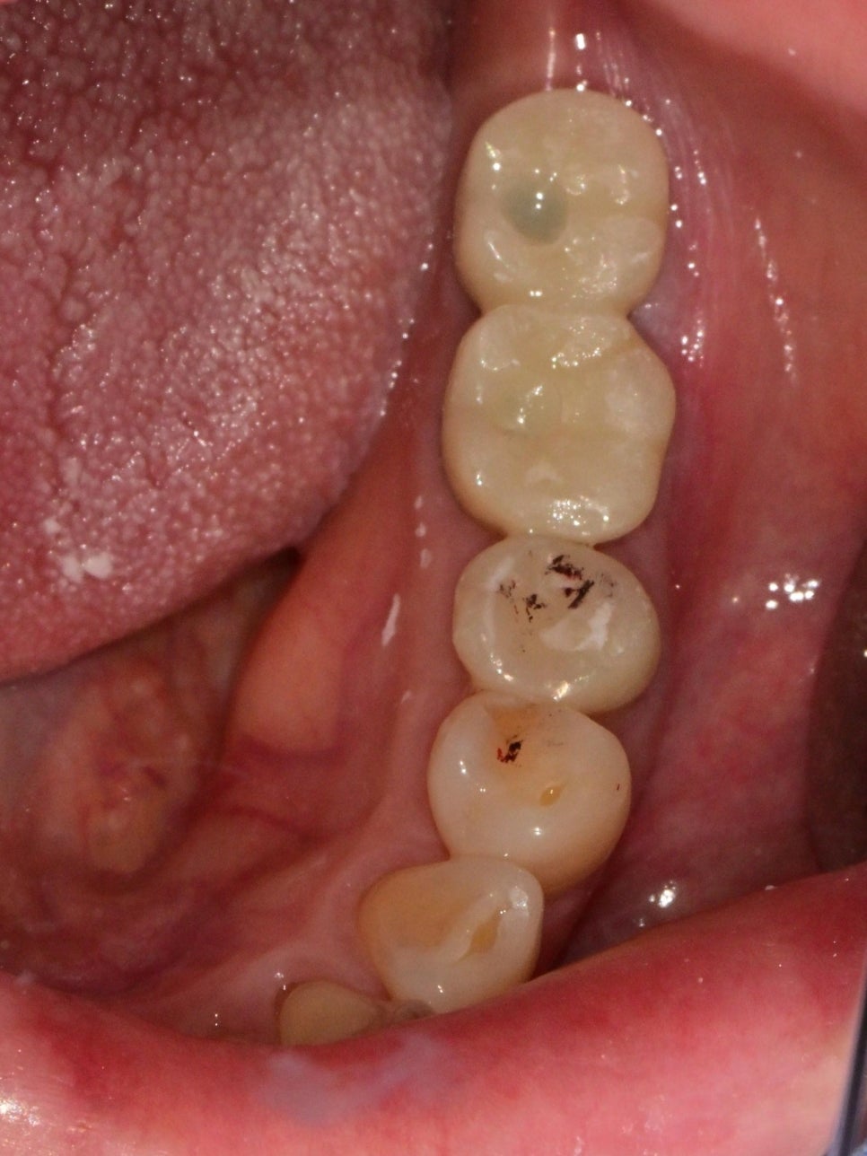 Munjeong-dong Dental Clinic, Bone Graft Implant Process&middot; What If You’ve Lost a Molar? image 11
