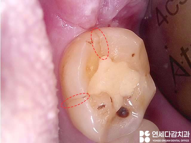 어금니 깨짐, 치아에 금 갔을 때 찌릿한 통증 가락시장역 치과 신경치료 후 크라운 꼭 씌워야 되는 이유와 예방법 관련 이미지 2