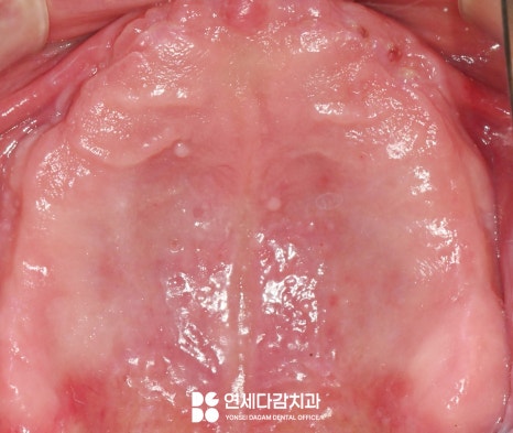 불편한 틀니 임플란트로 바꿔 치료할 수 있을지 가락시장역 치과 에서 살펴봅시다. 관련 이미지 5