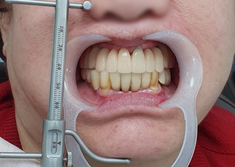 Prosthetics After Implants in Ogeum-dong: Occlusion and Facial Balance Matter Too image 5