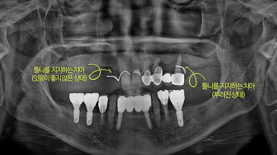 Songpa Station Dentist: Have You Been Using Dentures for a Long Time? <Digital Guided Implants> image 1