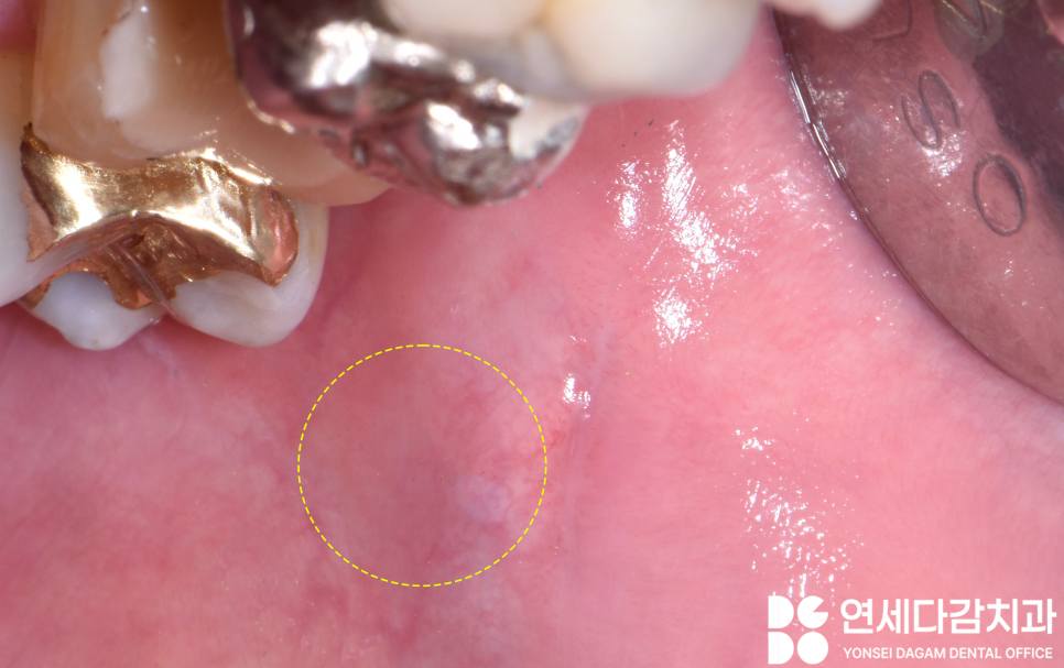 입안에 혹이 느껴진다면 외상성 섬유종 의심해 볼 수 있습니다 개롱역 치과 에서 알려드리는 원인과 치료방법 관련 이미지 6