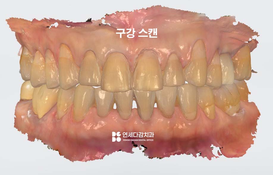 누런이 미백 안 해도 하얀이 원할 때 송파동 치과 최소삭제 라미네이트 과정에서 잇몸 치은 성형술 필요한 이유 관련 이미지 4