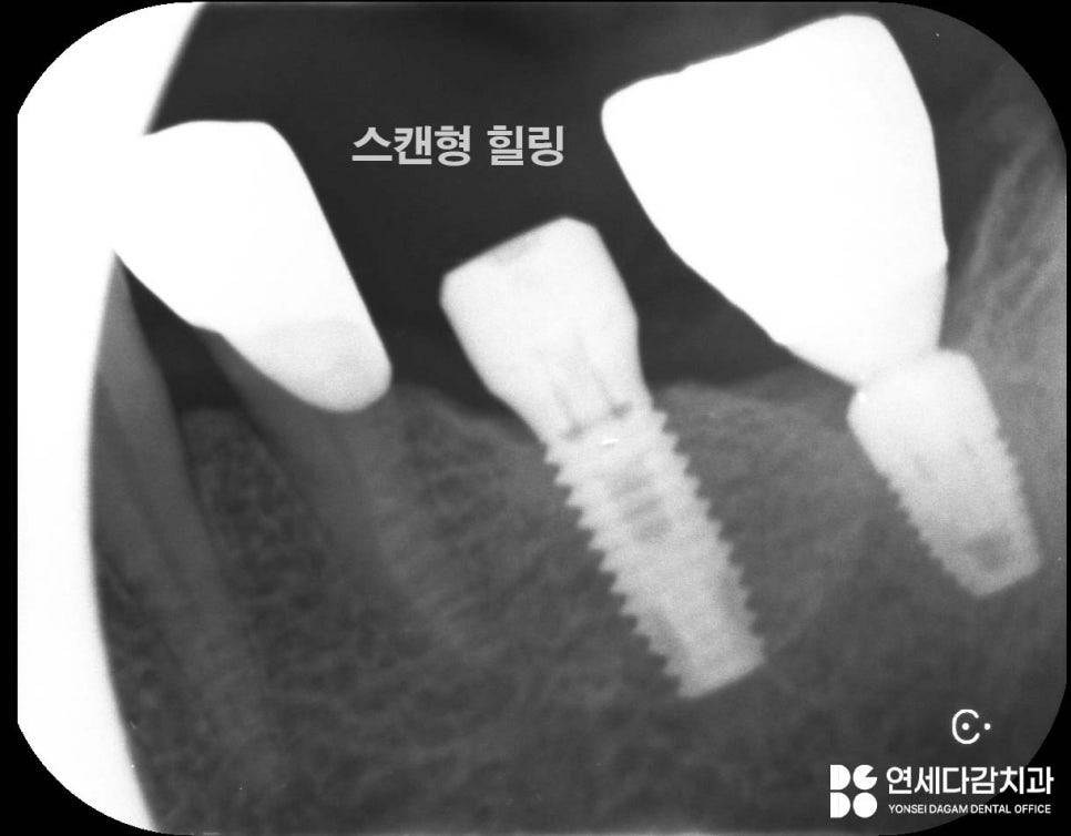 개롱역 치과 오스템 임플란트 종류의 다양성과 형태 구분법, 이것을 이용한 재수술 없는 보철 치료 관련 이미지 6