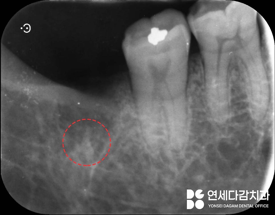 If the gums keep swelling and pus keeps coming out after impacted wisdom tooth extraction, how to find tooth root fragments remaining in the jawbone at a dental clinic in Songpa District image 2