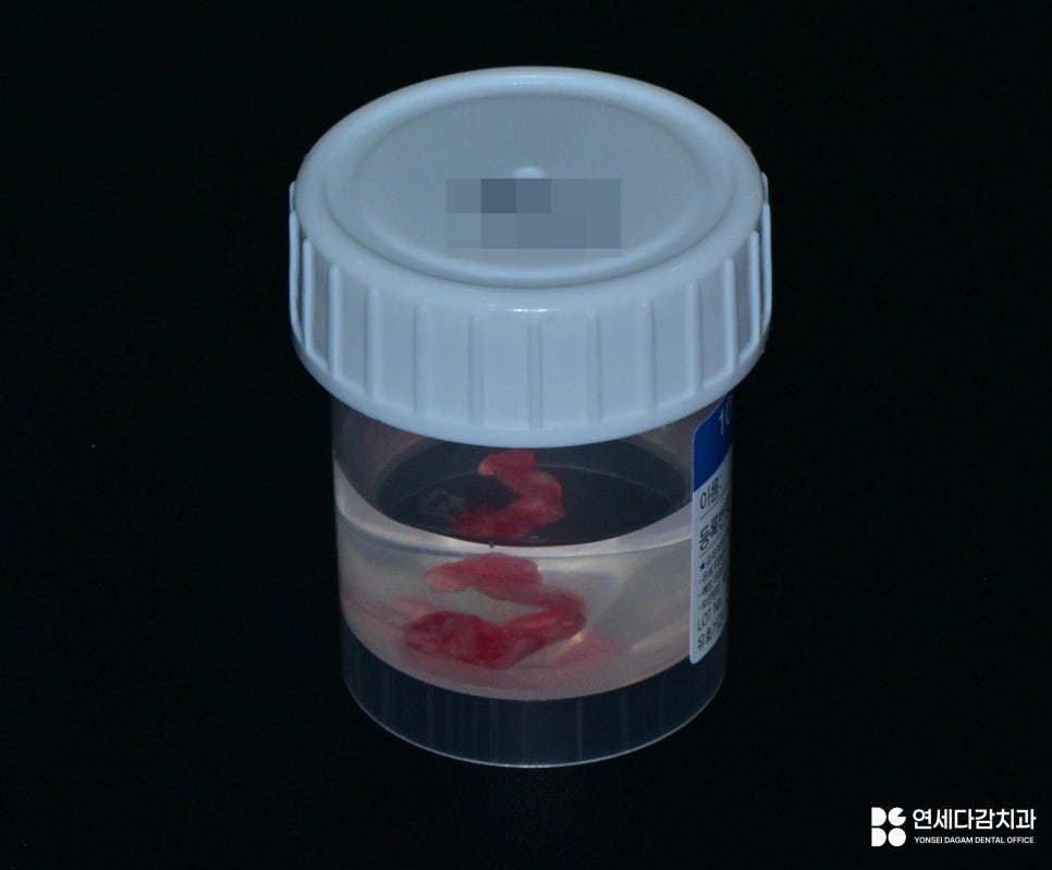 가락동 치과 교정 치료 전 사랑니 발치 꼭 필요할까? - 미성숙 매복케이스로 알아보는 과정 관련 이미지 10