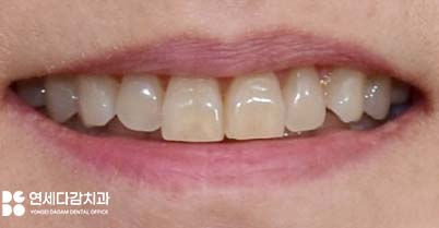 누런이 미백 안 해도 하얀이 원할 때 송파동 치과 최소삭제 라미네이트 과정에서 잇몸 치은 성형술 필요한 이유 관련 이미지 6