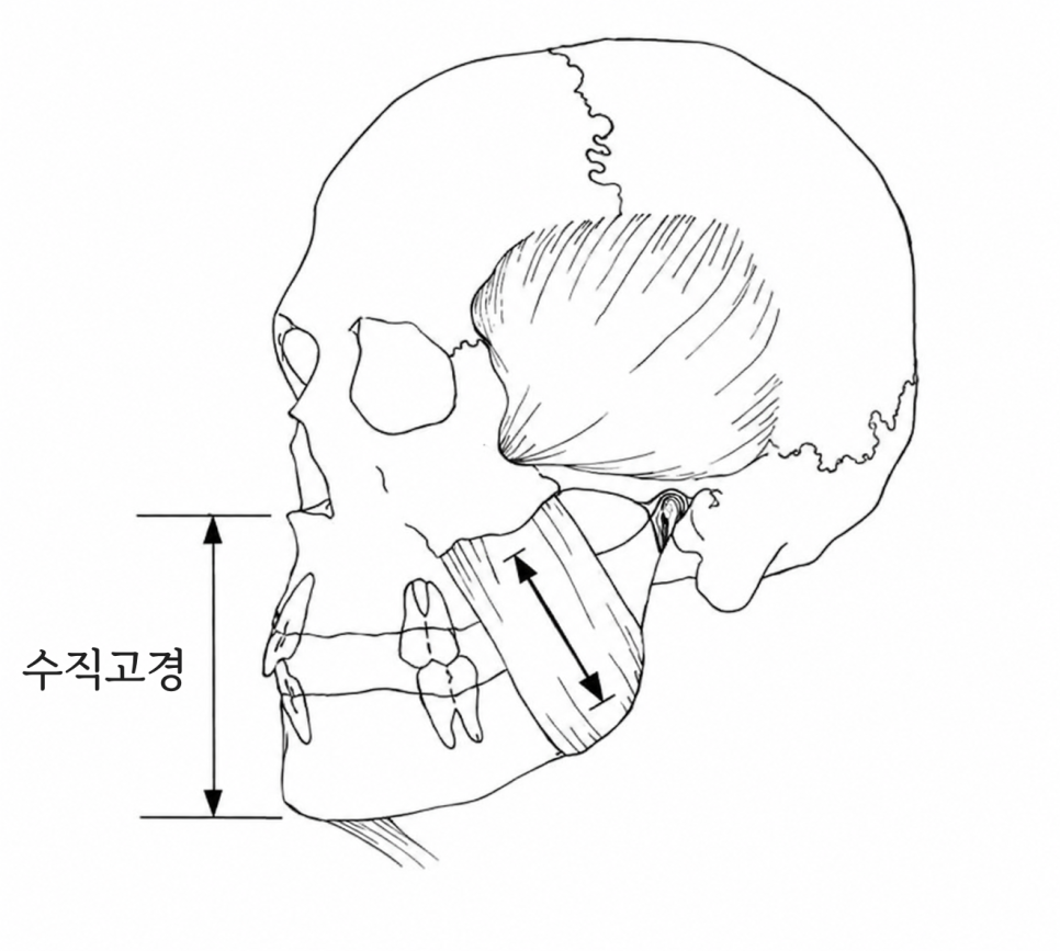 개롱역 치과 오래된 틀니, 이제는 전체 임플란트로 - 수직고경부터 안모 회복까지 관련 이미지 3