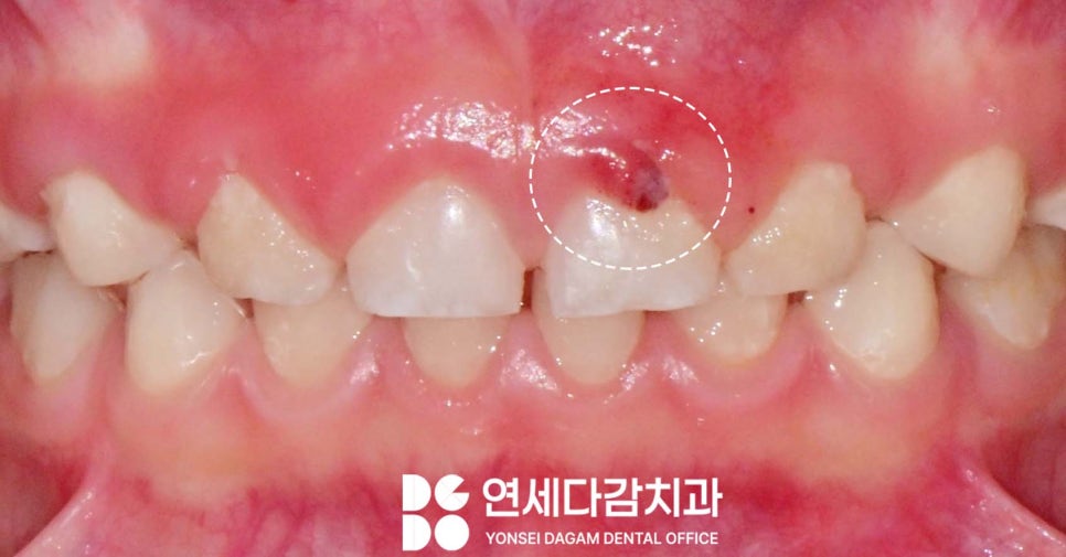 아이가 앞으로 넘어졌을 때 앞니 치료 확인법 거여역 치과 소아 치아 외상의 이해와 관리 관련 이미지 1