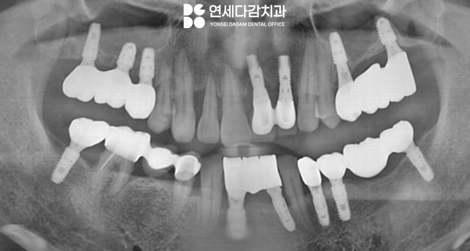 가락동 치과 오스템 임플란트 결과를 좌우하는 핵심 요소 표면처리 기술의 중요성 관련 이미지 5