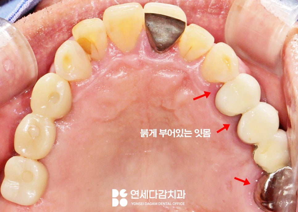 문정역 치과 임플란트 오래 사용하기 위해서 지대주 (어버트먼트) 보철 종류 기성 및 커스텀 지대주 (abutment) 차이 알고 받아야 되는 이유 관련 이미지 1