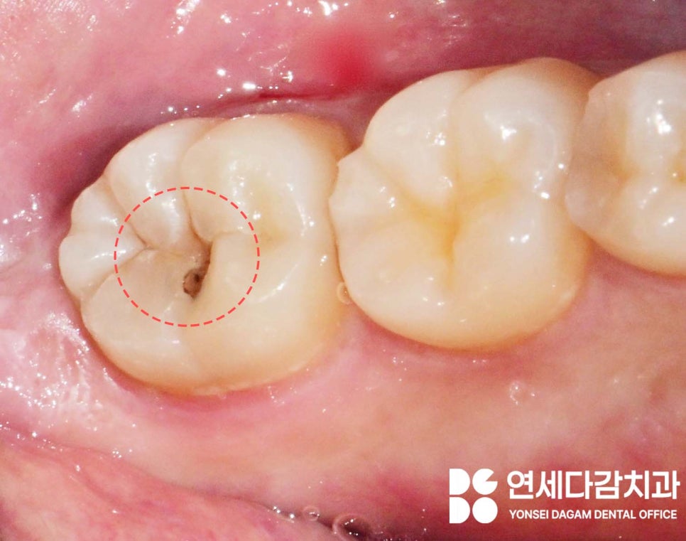 충치 범위에 따른 치료 방법 가락동 치과 레진 또는 인레이 언제 적용할 수 있을까? 관련 이미지 2