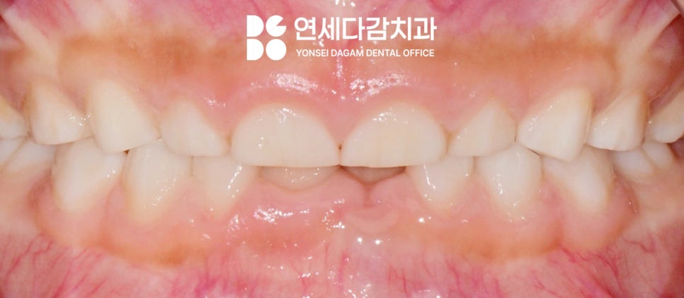 치아 마모 원인 소아 이갈이 치료 꼭 해야 될까 오금역 치과 에서 알아보는 원인과 관찰해야 될 징후들 관련 이미지 1