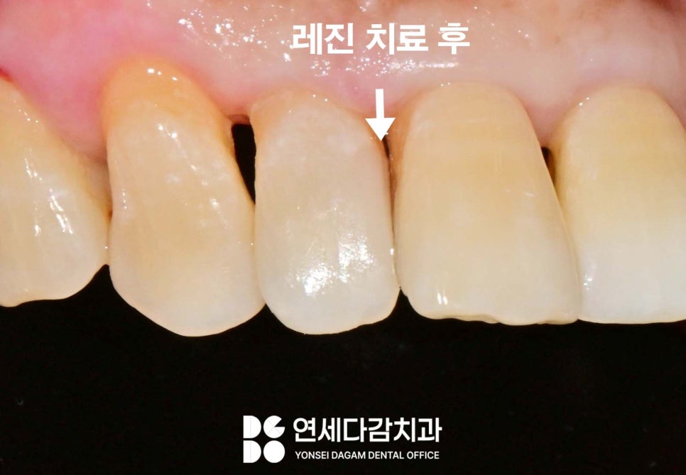 앞니 충치 꼭 크라운 해야 좋을까 송파역 치과 치아 사이 인접면 우식 레진 치료 만으로 충분한 경우 관련 이미지 5