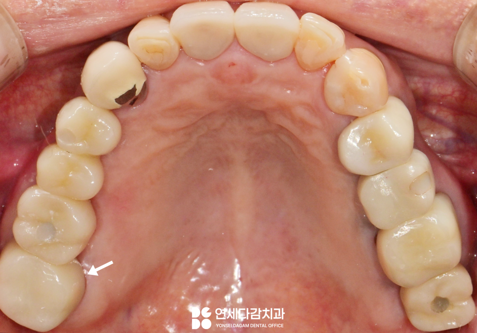 크라운 또는 브릿지 같은 보철 치료 했던 부위에 충치 또는 잇몸질환 생기는 이유 가락시장역 치과 치근우식 생겼을 때 발치 후 임플란트 관련 이미지 6