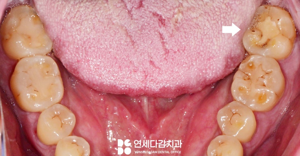 어금니 깨짐, 치아에 금 갔을 때 찌릿한 통증 가락시장역 치과 신경치료 후 크라운 꼭 씌워야 되는 이유와 예방법 관련 이미지 1