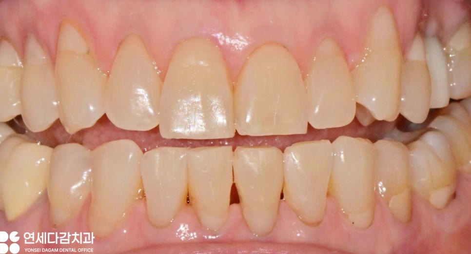 누런이 미백 안 해도 하얀이 원할 때 송파동 치과 최소삭제 라미네이트 과정에서 잇몸 치은 성형술 필요한 이유 관련 이미지 1