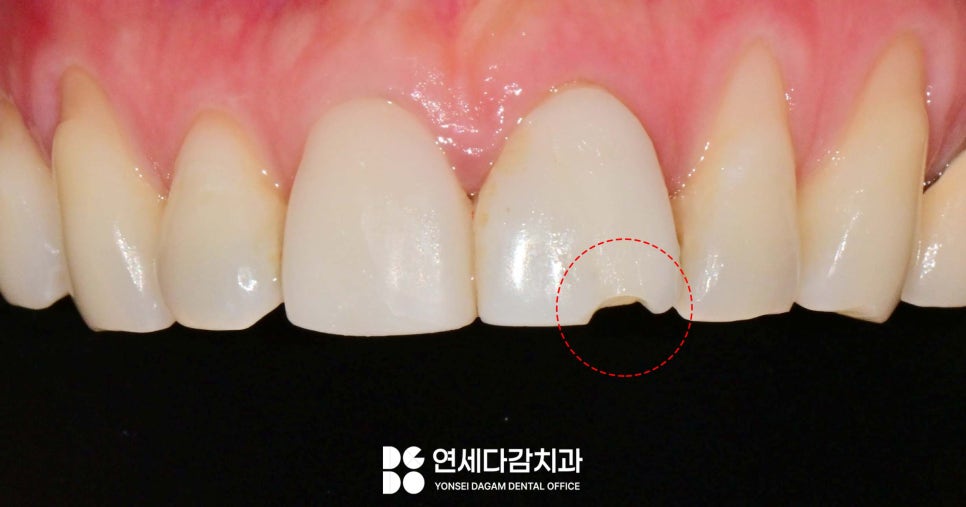 과거와 다르게 앞니 무삭제 라미네이트 가능한 이유 거여역 치과 앞니 보철 깨짐 추가 삭제 없이 재제작 관련 이미지 2