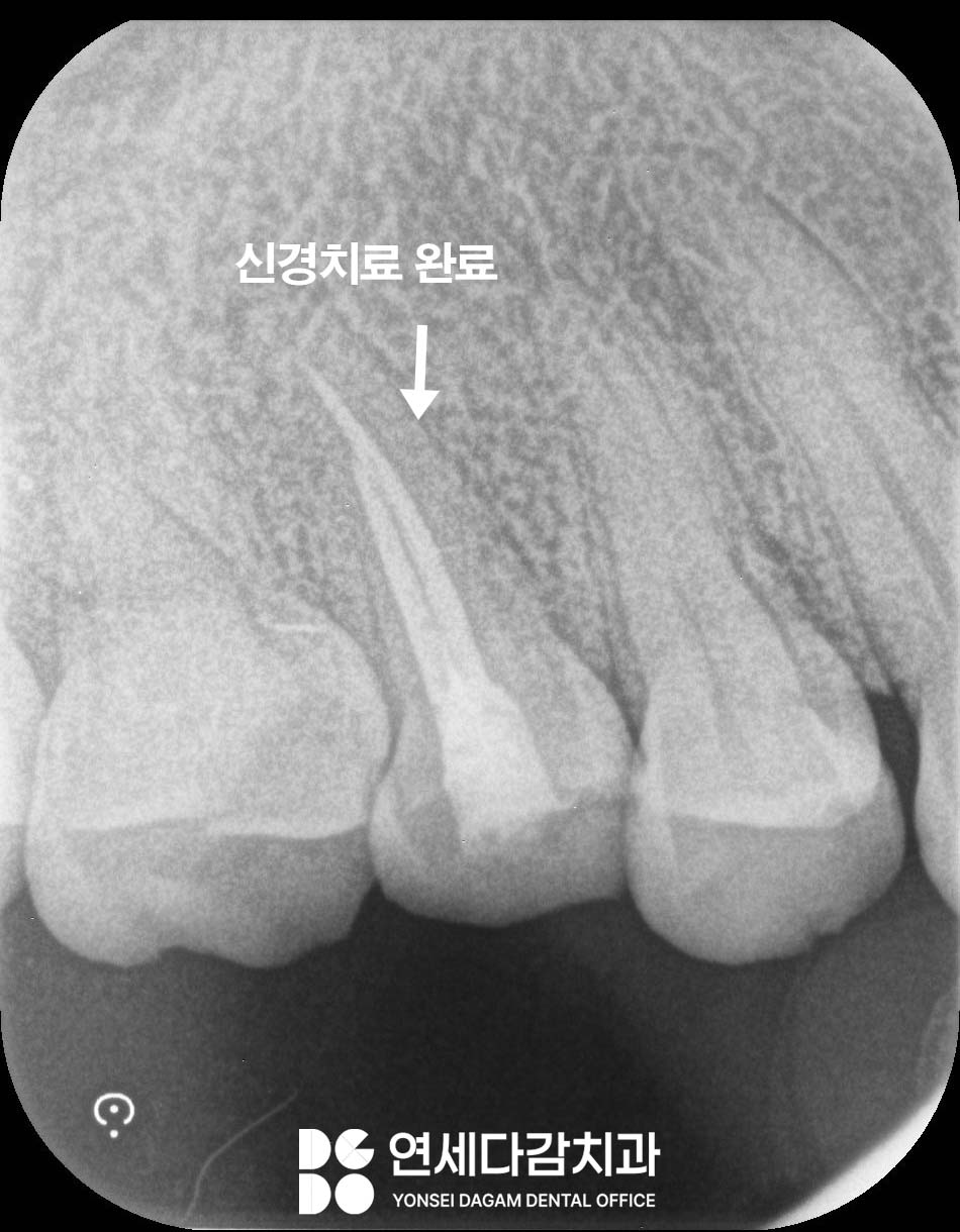 두통까지 아픈 어금니 치아 통증 송파역 치과 금간치아 신경치료 후 크라운 꼭 씌워야 되는 이유 관련 이미지 4