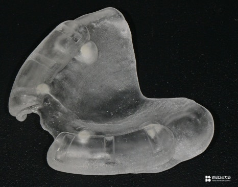 개롱역 치과 치주 질환으로 인한 심한 잇몸뼈 손실 - 네비게이션 방식 임플란트로 진행된 안전한 치료 관련 이미지 7