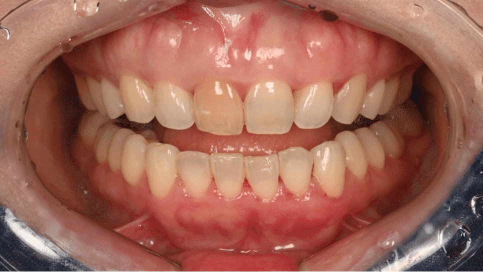 Geoyeo-dong Dental Clinic: Case of Internal Bleaching for a Discolored Front Tooth After Trauma image 7