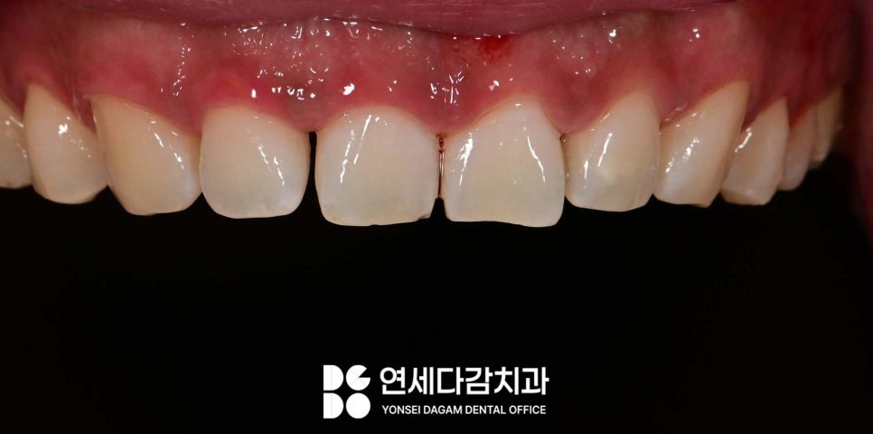 연세다감치과 심미 치료 무삭제 라미네이트 통해 자신감 있는 미소를 되찾는 여정 관련 이미지 4