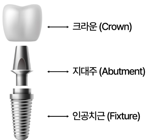오래된 임플란트 다시 수술하지 않고 크라운 교체만 가능할까 문정동 치과 SCRP 타입으로 보철 재제작 관련 이미지 3