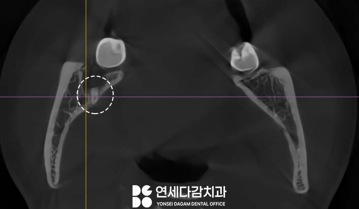 거여동 치과 매복 사랑니 발치 후 치아 뿌리 조각 부러짐 잔존치근 일부러 남겨두는 이유 관련 이미지 8