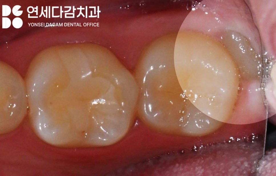 거여동 치과 매복 사랑니 발치 후 치아 뿌리 조각 부러짐 잔존치근 일부러 남겨두는 이유 관련 이미지 1