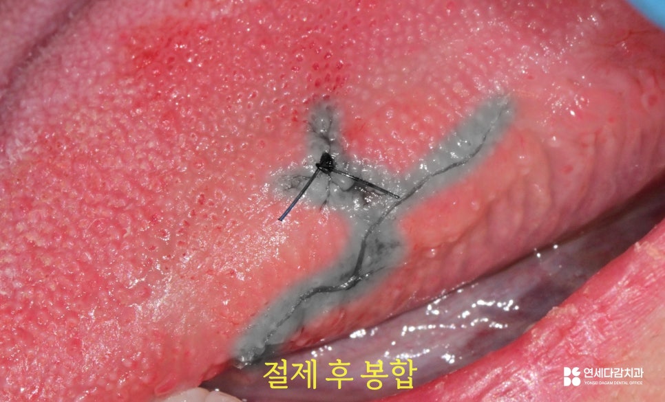 A Bump on the Side of the Tongue: From the Appearance of Oral Papilloma to Treatment | Gaerong Station Dental Clinic image 4