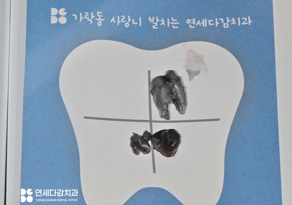 신경치료 후 크라운 떨어짐 원인으로 감염된 충치 치료 미루다 잇몸뼈 녹음 증상 개롱역 치과 발치 후 치근단 낭 적출술 관련 이미지 5