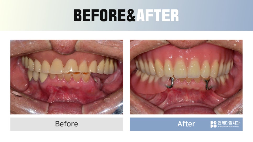 Seokchon-dong Dental Clinic, 연세다감치과: Why You Should Carefully Review the Denture-Making Steps · Process from the Beginning image 6