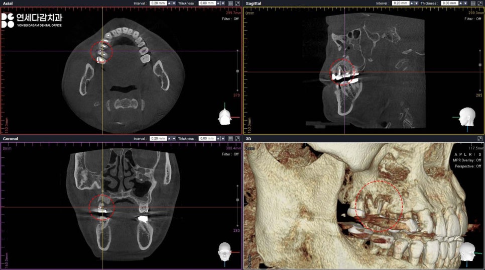 축농증 수술 후에도 임플란트 수술 가능할까? 특별한 송파구 치과 케이스의 해결책 관련 이미지 2