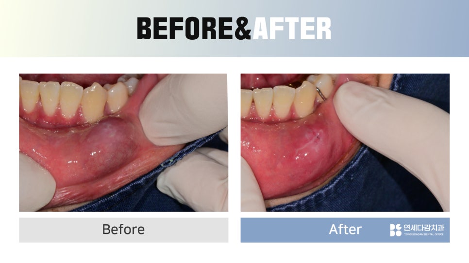 Geoyeo Station Dental Clinic, Mucous Cyst Removal&middot;What If a Lump-Like Bump Protrudes Inside Your Mouth? image 9
