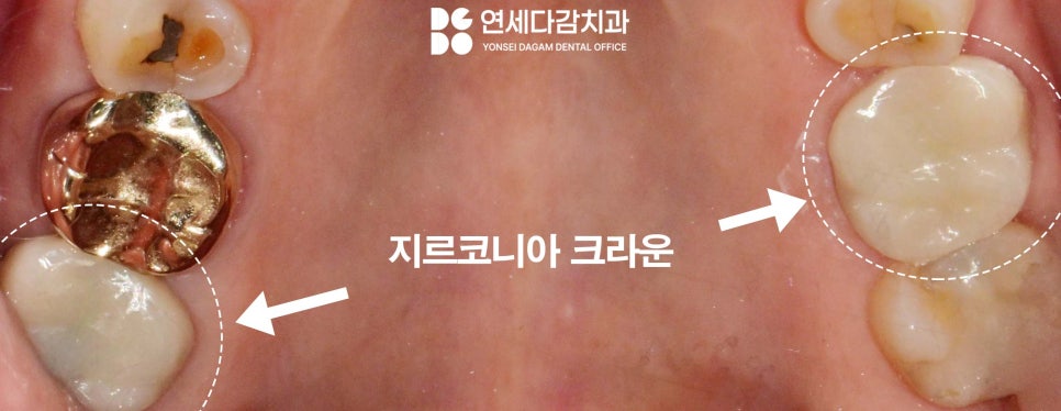 크라운 빠졌을 때 다시 붙일 수 있을까 문정동 치과 구강 스캐너 통한 보철 제작 관련 이미지 6