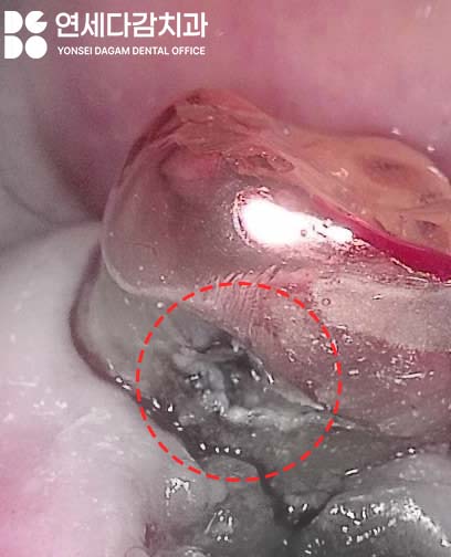 크라운 또는 브릿지 같은 보철 치료 했던 부위에 충치 또는 잇몸질환 생기는 이유 가락시장역 치과 치근우식 생겼을 때 발치 후 임플란트 관련 이미지 5