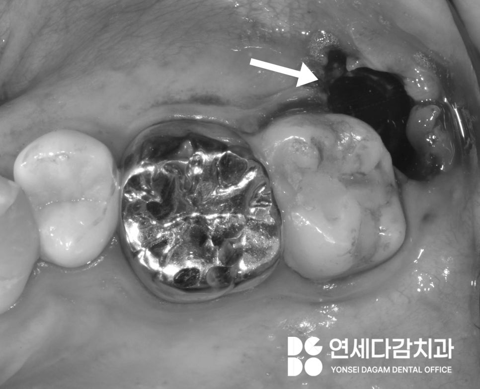 매복 사랑니 발치 시 관련 이미지 6