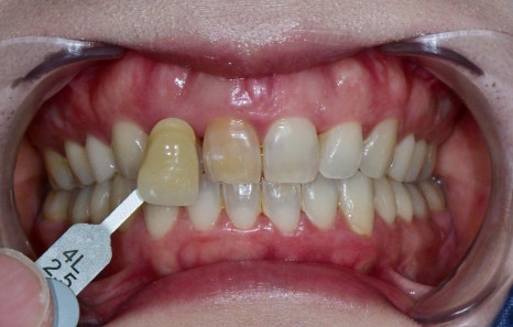 Geoyeo-dong Dental Clinic: Case of Internal Bleaching for a Discolored Front Tooth After Trauma image 6
