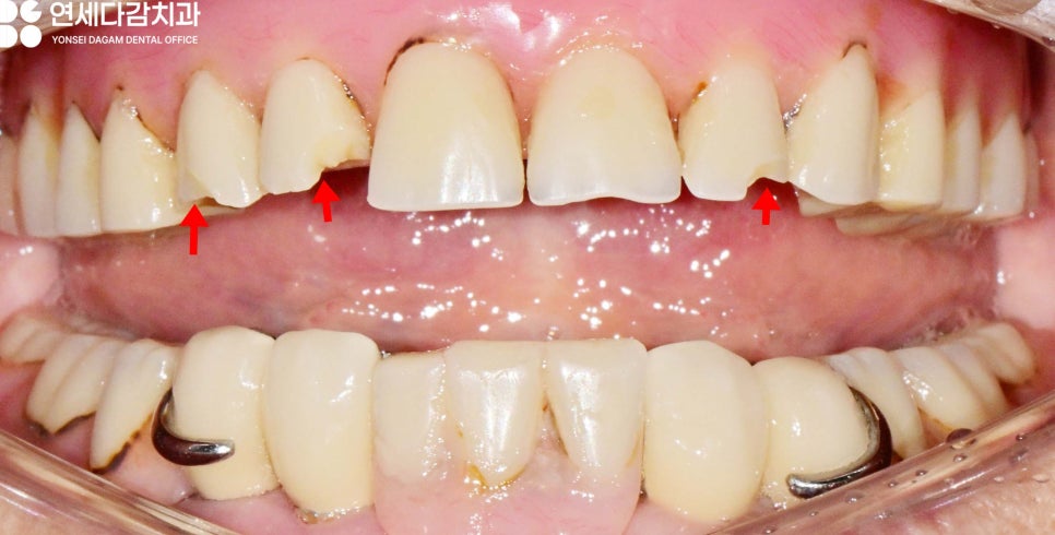 거여동 치과 임플란트 틀니 깨졌을 때 오버덴처 overdenture 종류 및 수리 기간 관련 이미지 3