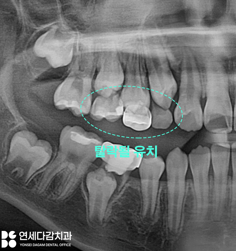 유치 빠지고 영구치 나는 시기 지났는데도 안 나온다면 문정역 치과 선천적 결손 치아 자리 지키기 위한 비발치 충치 치료 크라운 관련 이미지 1