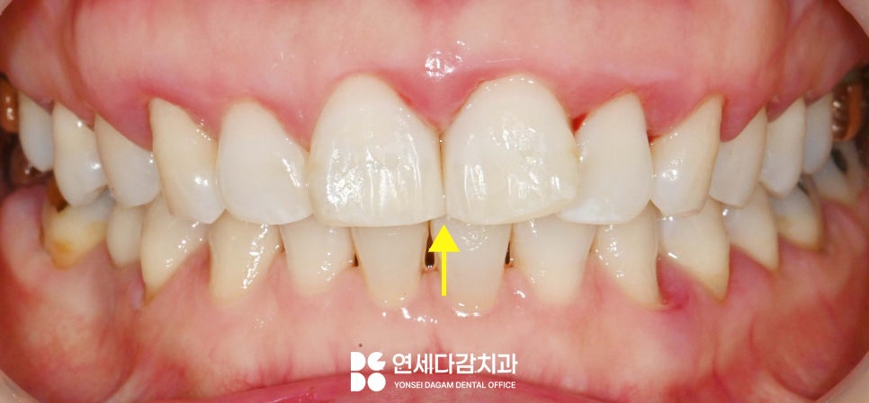 앞니 사이 벌어짐, 틈(치간이개) 문정역 치과 에서 선택하는 치료 방법 관련 이미지 4
