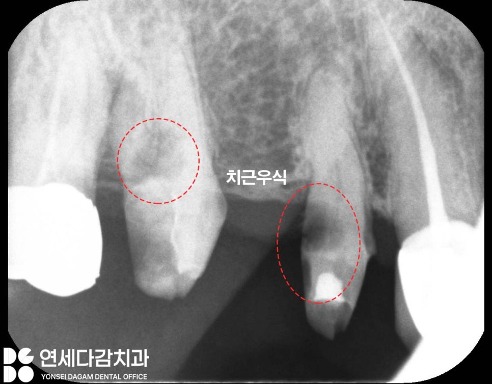 크라운 또는 브릿지 같은 보철 치료 했던 부위에 충치 또는 잇몸질환 생기는 이유 가락시장역 치과 치근우식 생겼을 때 발치 후 임플란트 관련 이미지 3