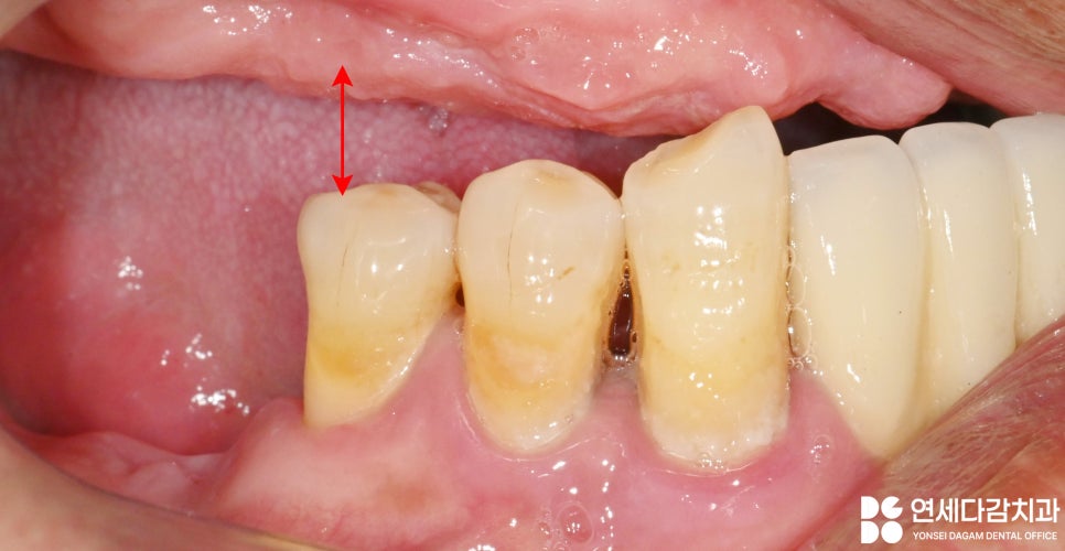 불편한 틀니 임플란트로 바꿔 치료할 수 있을지 가락시장역 치과 에서 살펴봅시다. 관련 이미지 3