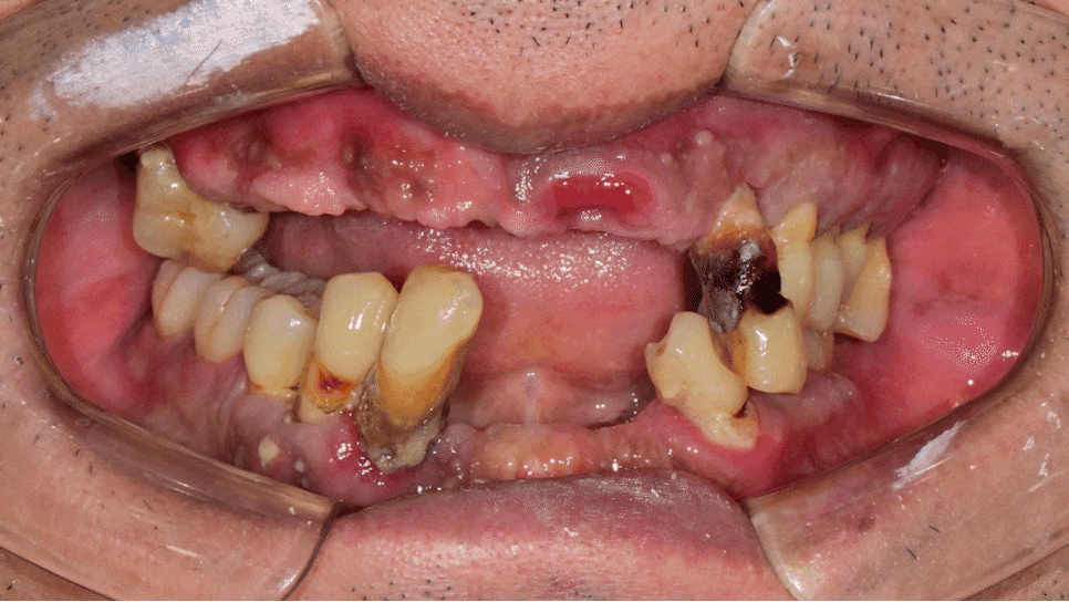 Temporary Teeth After Implants in Songpa-dong: Why They Can Be Provided Quickly image 11