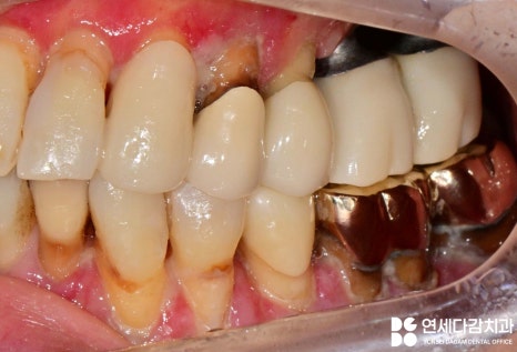 잇몸이 붓고 피나고 냄새날 때 송파역 치과 구강암 증상과 비슷한 급성 궤양성 치은염 (ANUG) 잇몸치료 통한 치주질환 개선 관련 이미지 3