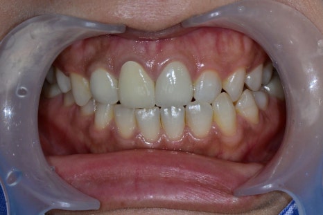 Macheon-dong Dental Clinic: Why Treating Root Inflammation Comes First Before an Anterior Crown image 5